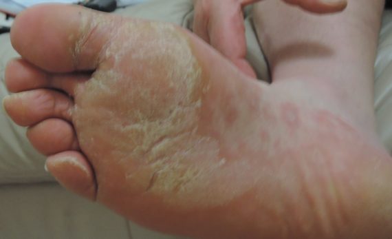 image of Curing Eczema - part 2