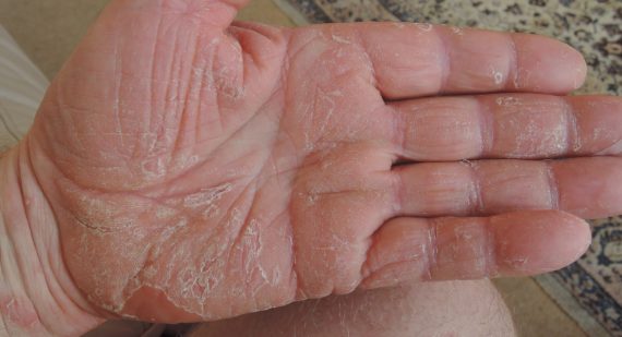 image of eczema